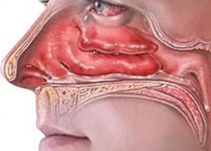 Allergic rhinitis